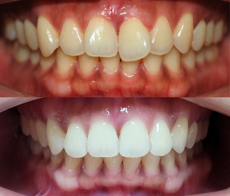 강남원진치과, 앞니부분교정 &lsquo;이 기준&rsquo; 확인하세요 관련 이미지 12