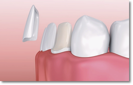 When Is Partial Orthodontic Treatment for the Front Teeth Possible? image 7