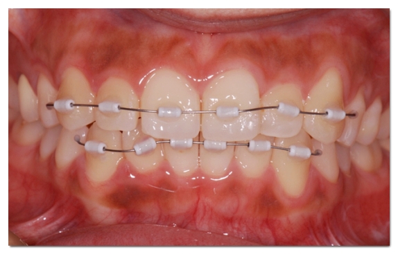 Can Malocclusion Be Treated with Veneers Without Orthodontics? image 10