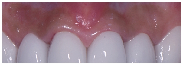 How Should You Choose a Laminate Veneer Dentist in Yeoksam-dong? image 4