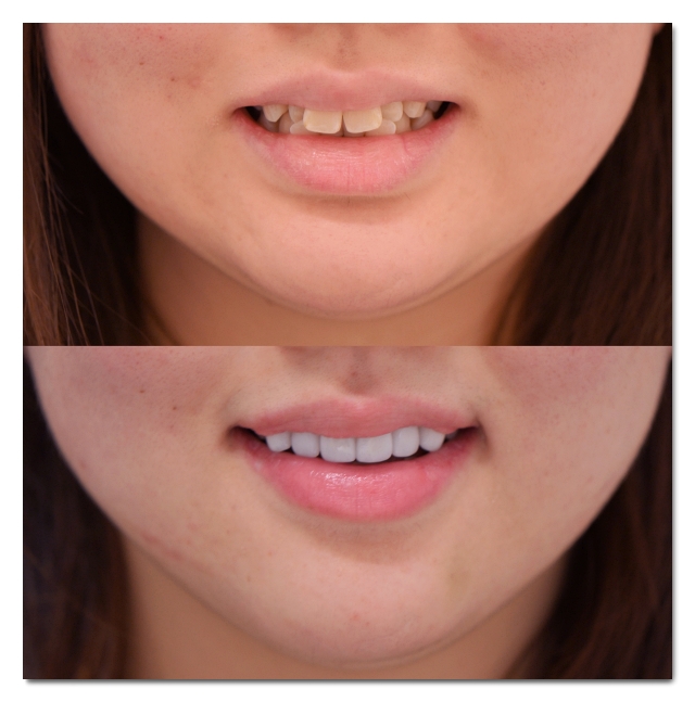 One-Day Teeth Whitening? How to Brighten Your Front Teeth in Just One Day image 7