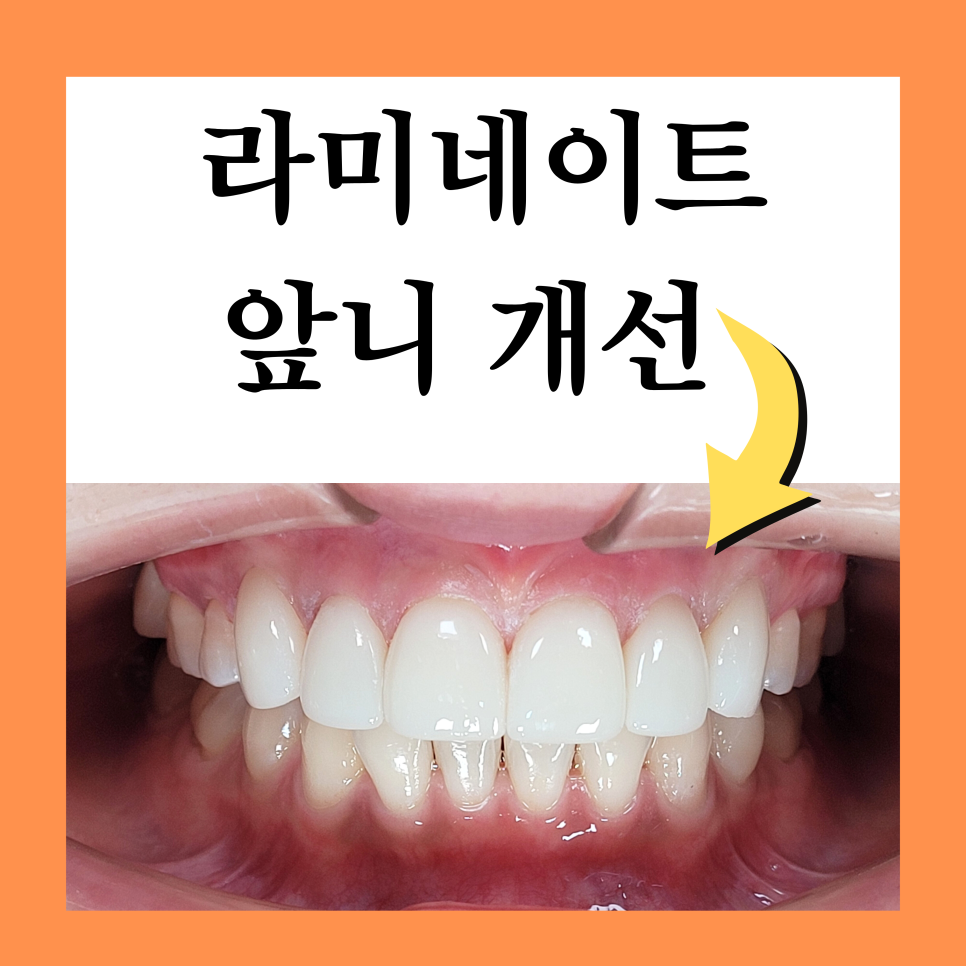 양재역 라미네이트, 과하지 않게 앞니 개선 가능한가요? 관련 이미지 2