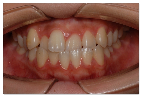Can Malocclusion Be Treated with Veneers Without Orthodontics? image 5