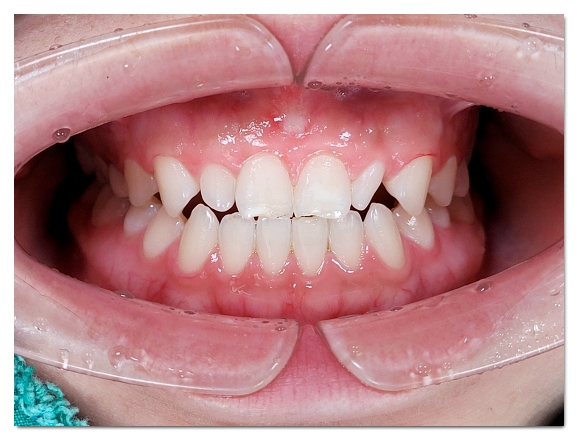 Can Malocclusion Be Treated with Veneers Without Orthodontics? image 7