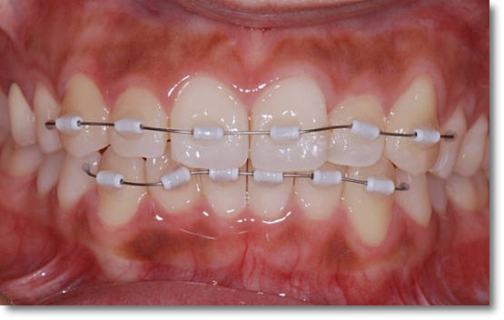 When Is Partial Orthodontic Treatment for the Front Teeth Possible? image 5