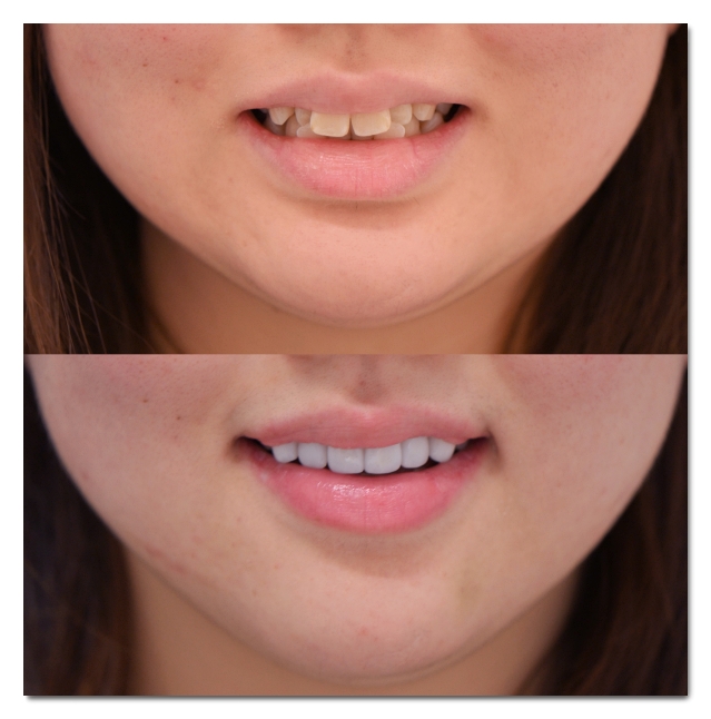How to Choose a Good Laminate Dental Clinic Near Gangnam Station image 3