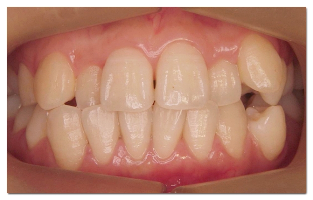 Which Is Better for Crowded Teeth: Veneers or Orthodontic Treatment? image 3