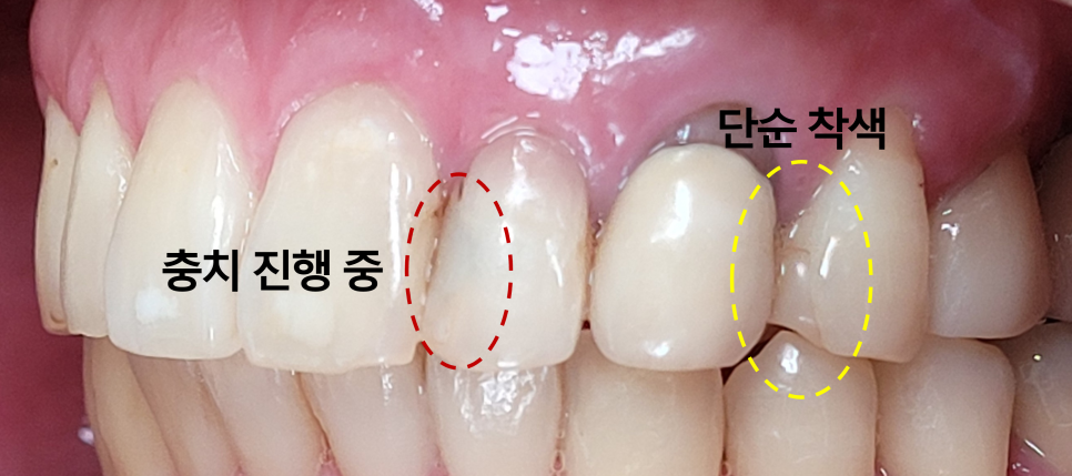 A Complete Guide to the Causes of Front Tooth Resin Discoloration and Solutions by Type image 8