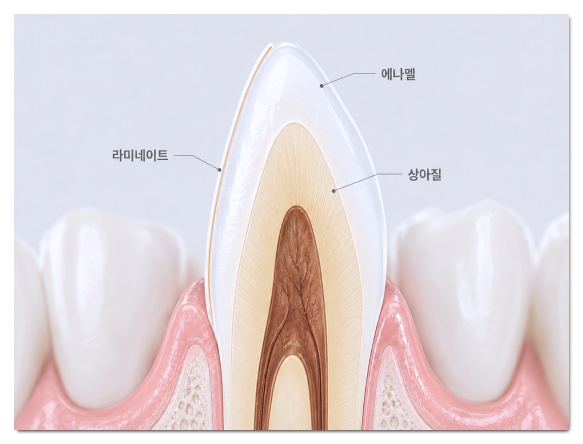라미네이트 치아삭제 최소화하는 방법 3가지 관련 이미지 2