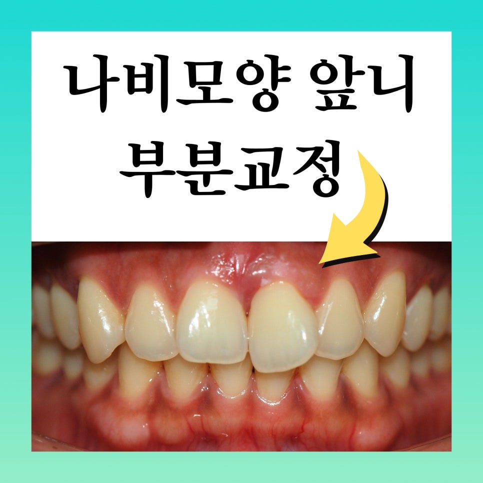 강남원진치과, 앞니부분교정 &lsquo;이 기준&rsquo; 확인하세요 관련 이미지 2