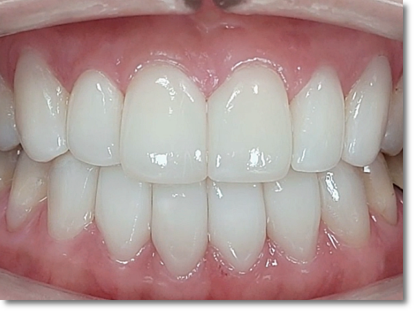 When Is Partial Orthodontic Treatment for the Front Teeth Possible? image 8