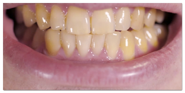 Teeth Whitening Costs, DIY Comparison, Procedure, Duration, and Care: A Complete Guide image 6