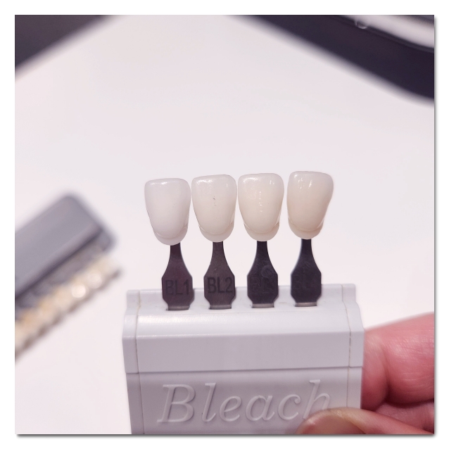 Teeth Whitening Costs, DIY Comparison, Procedure, Duration, and Care: A Complete Guide image 9