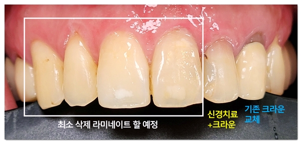 라미네이트 크라운 차이, 내 치아에 맞는 방법은? 관련 이미지 2