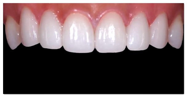 Celebrity Veneers: How Are They Different from Regular Veneers? image 2