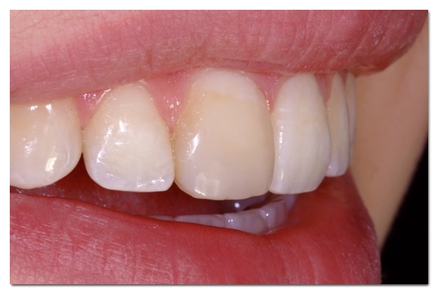 One-Day Teeth Whitening? How to Brighten Your Front Teeth in Just One Day image 2