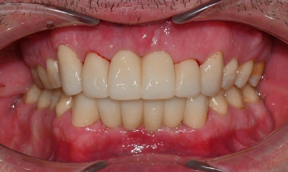 과개교합과 손상된 앞니, 심미와 기능을 함께 회복한 앞니 심미보철 케이스 관련 이미지 8