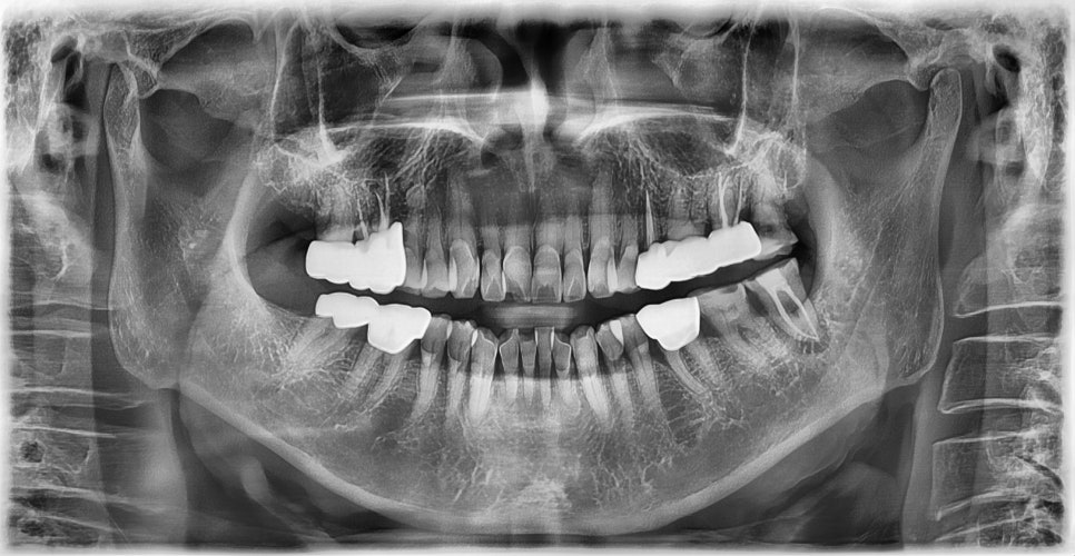 임플란트와 고혈압, 당뇨, 골다공증 등의 전신질환 관련 이미지 2