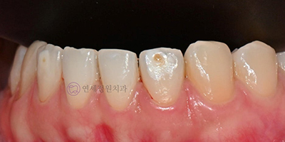 ICON Resin Treatment: White Spots on Front Teeth - Are They Cavities? 관련 이미지 5