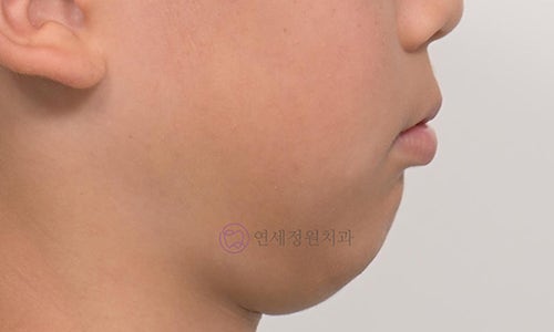 My Child Has a Receding Chin—Is It Simply Hereditary? Why It Shouldn’t Be Left Untreated image 3