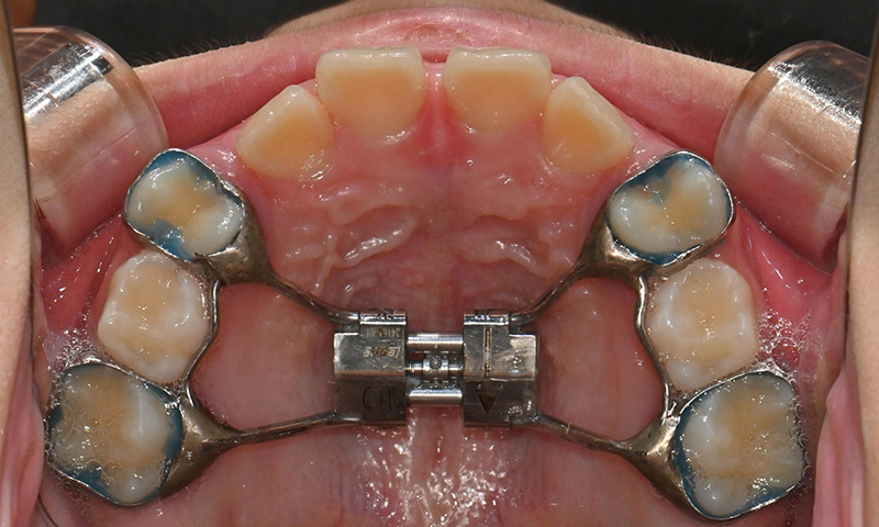 악궁확장장치(RPE, MARPE, MSE) 돌리는 방법 관련 이미지 5