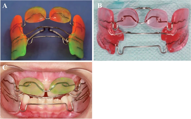 유학생 치아교정, 인비절라인 연세정원치과 관련 이미지 5