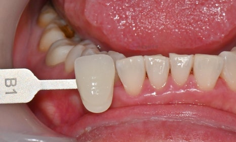 원데이 치아미백 - 앞니 크라운 사례 관련 이미지 8