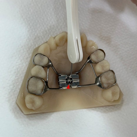 악궁확장장치(RPE, MARPE, MSE) 돌리는 방법 관련 이미지 12