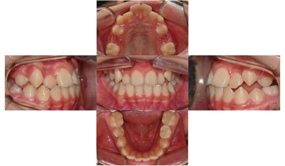 어린이 주걱턱 교정 - 페이스 마스크와 인비절라인 퍼스트 관련 이미지 5