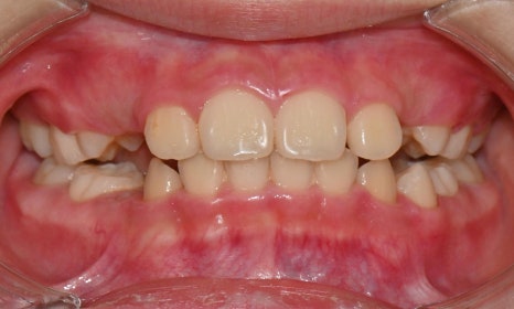 Why Is a Second Phase of Orthodontic Treatment Needed After the First? – A Case of Invisalign Treatment for a Growing Patient with Anterior Crossbite image 6