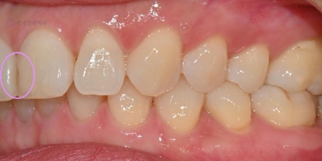 앞니 심미 레진 치료 : 블랙트라이앵글, 앞니 사이 공간 @ 대치동 연세정원치과 관련 이미지 11