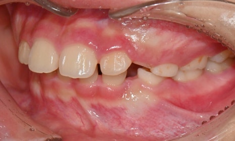 Why Is a Second Phase of Orthodontic Treatment Needed After the First? – A Case of Invisalign Treatment for a Growing Patient with Anterior Crossbite image 5