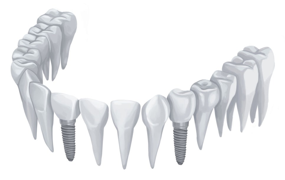 임플란트 치료는 어떤 순서로 진행될까요? @대치동임플란트 연세정원치과의원 관련 이미지 2
