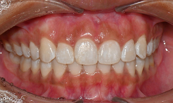 인비절라인 앞니 사이 공간 및 덧니 교정 관련 이미지 12