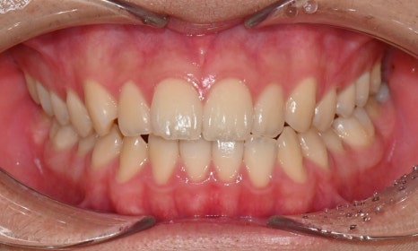 치아 중심선 비대칭과 아랫입술 돌출 개선 관련 이미지 25