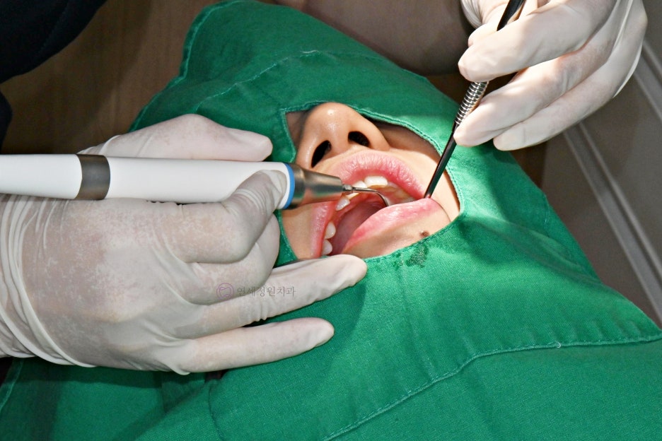 One Day Teeth Whitening Process @ Yonsei JW Dental Clinic 관련 이미지 2