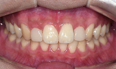 Front Tooth Resin Treatment in Korea: Microdontia, Gaps & Black Triangles 관련 이미지 7