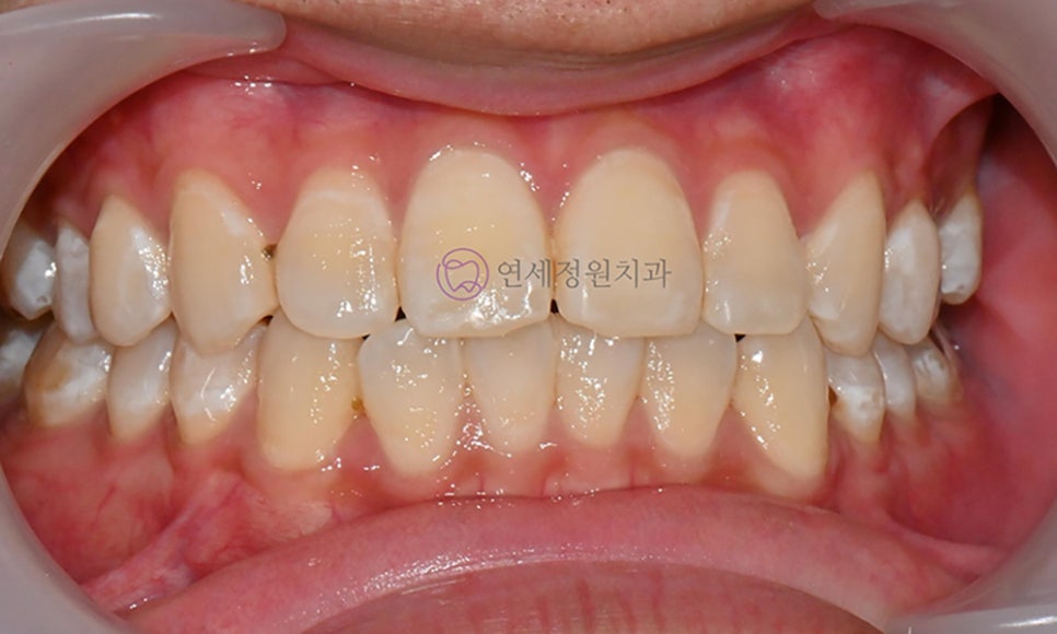 치아 미백 후 반점치의 아이콘 레진 치료 @ 대치동 연세정원치과 관련 이미지 5