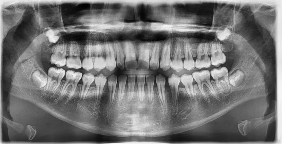 어린이 주걱턱, 페이스 마스크 성장교정 후 인비절라인 관련 이미지 4