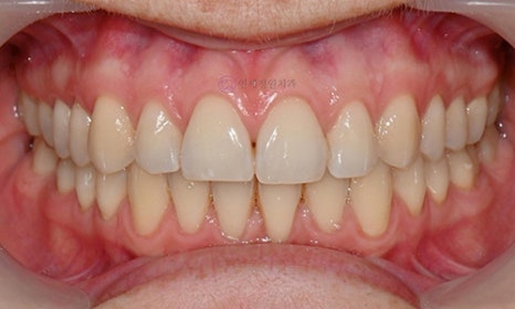 Teeth Whitening Case : A couple from the Netherlands 관련 이미지 7