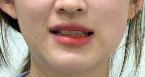 치아 중심선이 안 맞아요! 치아 비대칭 교정으로 가능할까요? @ 대치동 교정치과 연세정원치과 관련 이미지 25