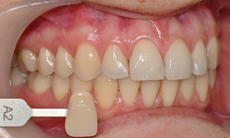 원데이 치아미백 @ 대치동치과 연세정원치과 관련 이미지 9