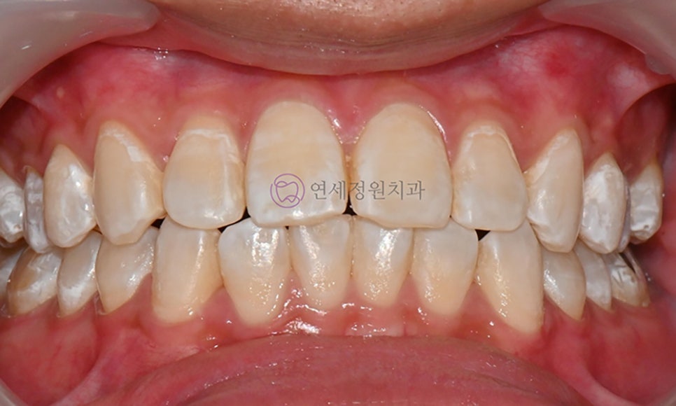 치아 미백 후 반점치의 아이콘 레진 치료 @ 대치동 연세정원치과 관련 이미지 9