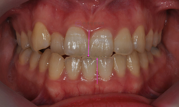 치아 중심선이 안 맞아요! 치아 비대칭 교정으로 가능할까요? @ 대치동 교정치과 연세정원치과 관련 이미지 24