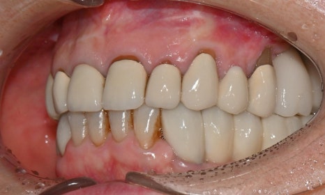 심미와 기능을 모두 고려한 앞니 심미보철 재치료 관련 이미지 5