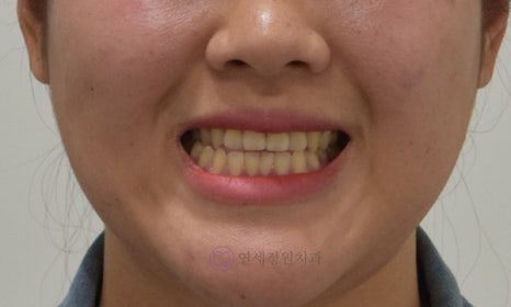 치아 중심선 비대칭 및 개방교합 교정, 대치동 연세정원치과 관련 이미지 14