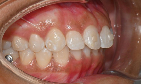 개포동 앞니 사이 공간 및 덧니 교정을 원한다면 관련 이미지 8