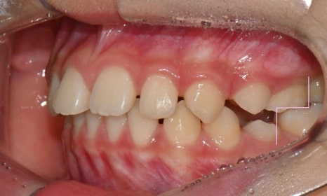 어린이 무턱 액티베이터 성장교정 후 인비절라인 퍼스트 관련 이미지 12