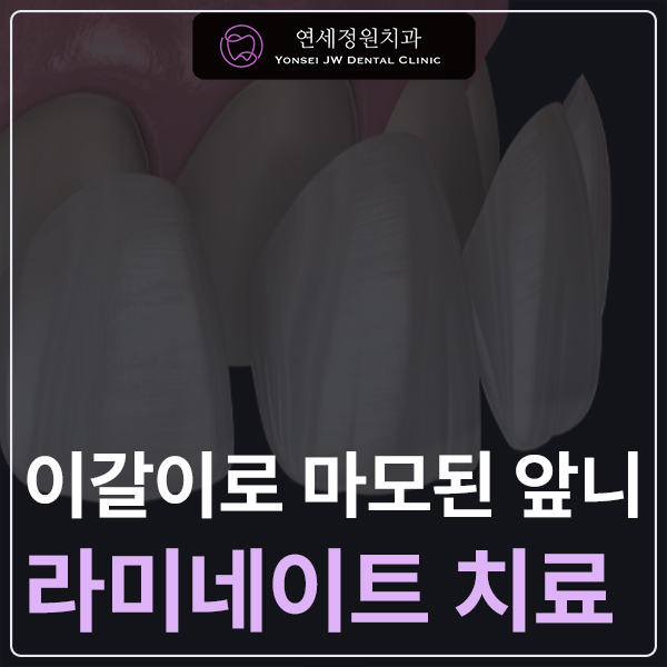 이갈이로 마모된 앞니 라미네이트 케이스 관련 이미지 1