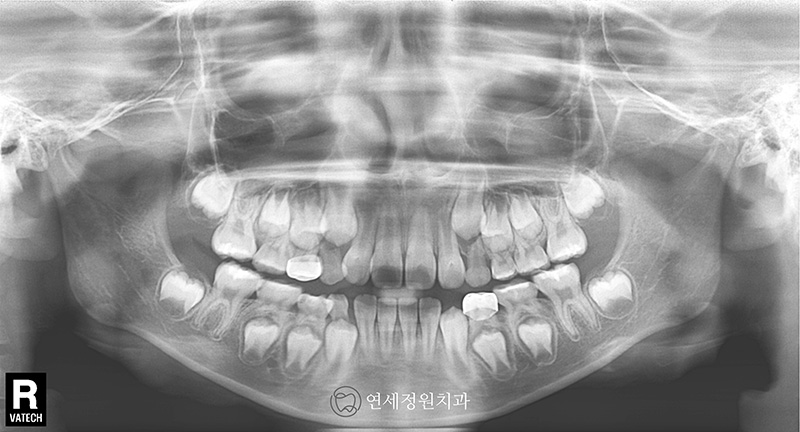 유학생 치아교정, 인비절라인 연세정원치과 관련 이미지 6